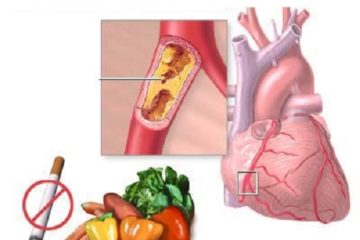 Cách phòng tránh bệnh tim mạch vành
